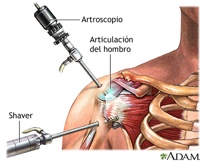 artroscopiar de hombro